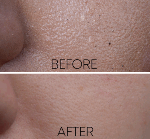Close-up of a persons cheek showing before and after images; the visible difference demonstrates how putting science